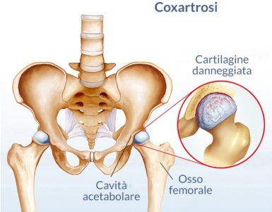 artrosi anca