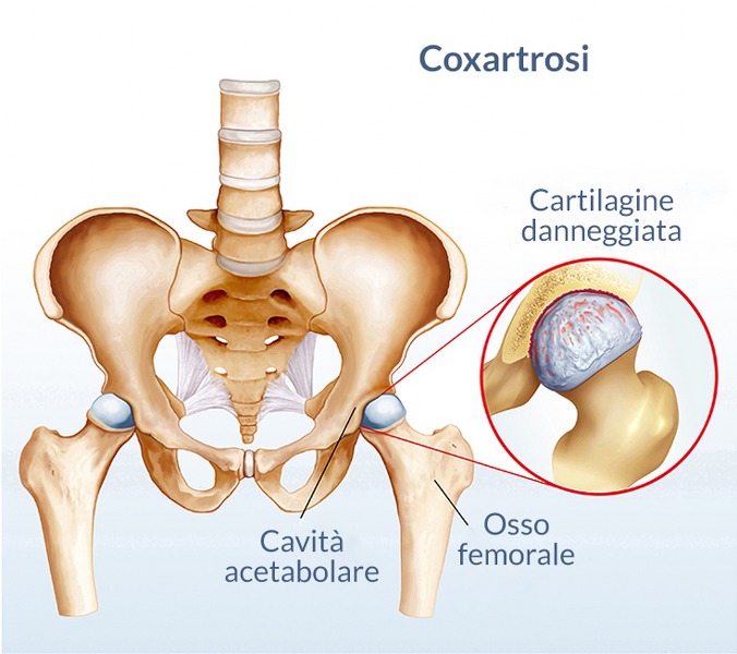 Coxartrosi: terapia conservativa e chirurgica per l’artrosi dell’anca