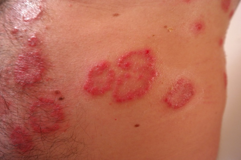 Dermatite, cosa c’è da sapere e quali sono i rimedi?