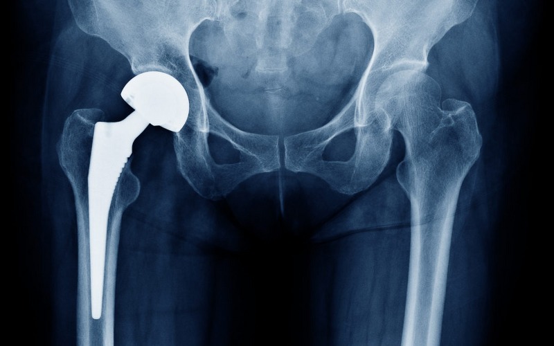 Protesi dell’anca, decorso e rischi di un intervento 
