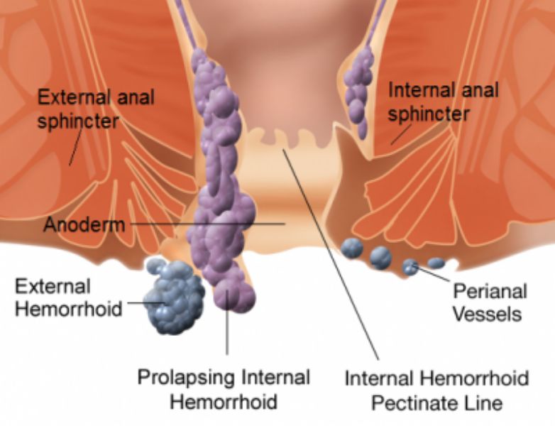 Emorroidi-interne-ed-esterne