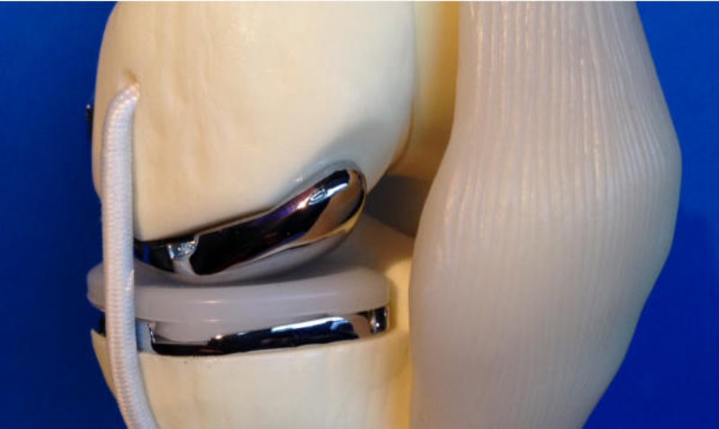Protesi ginocchio mini invasiva: la soluzione che non lascia tracce
