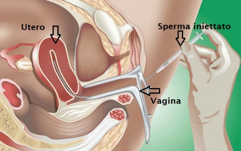 Fecondazione assistita eterologa in Italia: la situazione