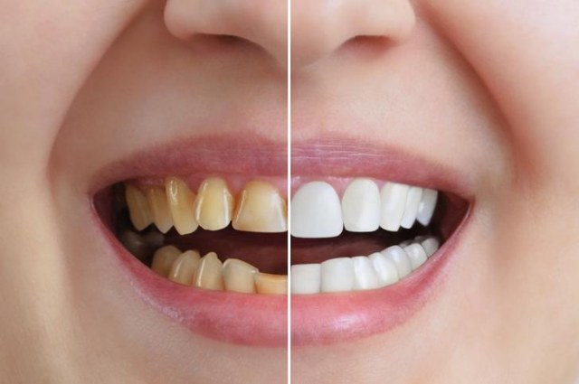 Lo sbiancamento dei denti: tutto quello che dovete sapere