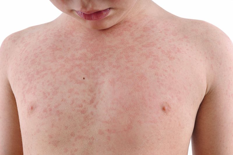 Malattie esantematiche bambini: macchie rosse sulla pelle senza prurito