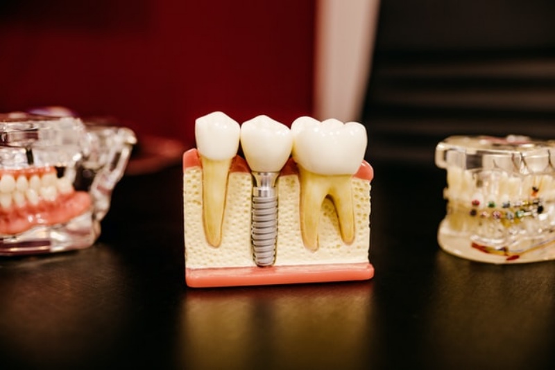 L’impianto dentale come soluzione per denti nuovi